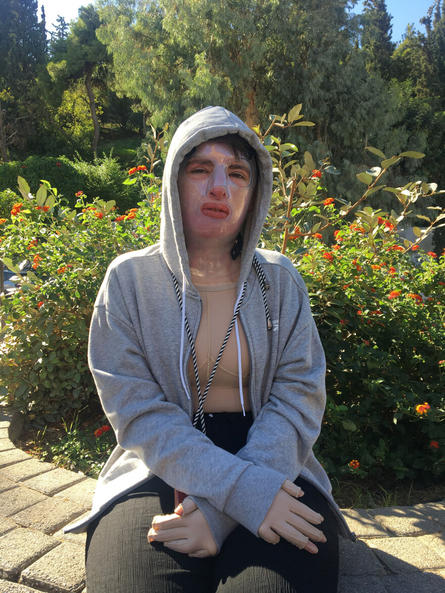 Πήλιο: «Είδα το πρόσωπό μου και ήταν η χειρότερη στιγμή της ζωής μου», λέει η 22χρονη που κάηκε ανάβοντας τη σόμπα