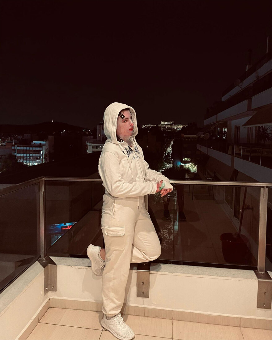 Πήλιο: «Είδα το πρόσωπό μου και ήταν η χειρότερη στιγμή της ζωής μου», λέει η 22χρονη που κάηκε ανάβοντας τη σόμπα