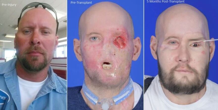 Νέα Υόρκη: Μεταμόσχευσαν για πρώτη φορά με επιτυχία ολόκληρο μάτι σε ασθενή - Δείτε φωτογραφίες