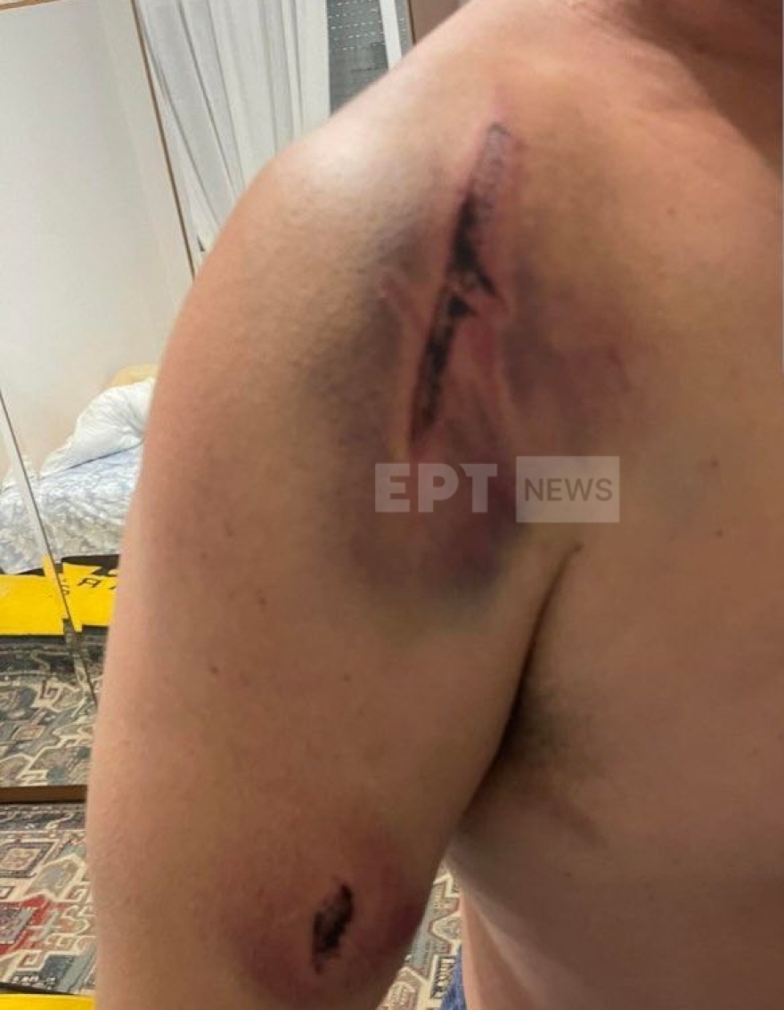 Θεσσαλονίκη: «Με χτυπούσαν στο κεφάλι και στο σώμα» - Η μαρτυρία του 54χρονου οδηγού του ΟΑΣΘ για την επίθεση από νεαρούς