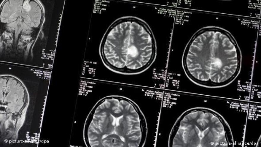 Ο Έλληνας νευροχειρουργός που τα βάζει με τον καρκίνο εγκεφάλου