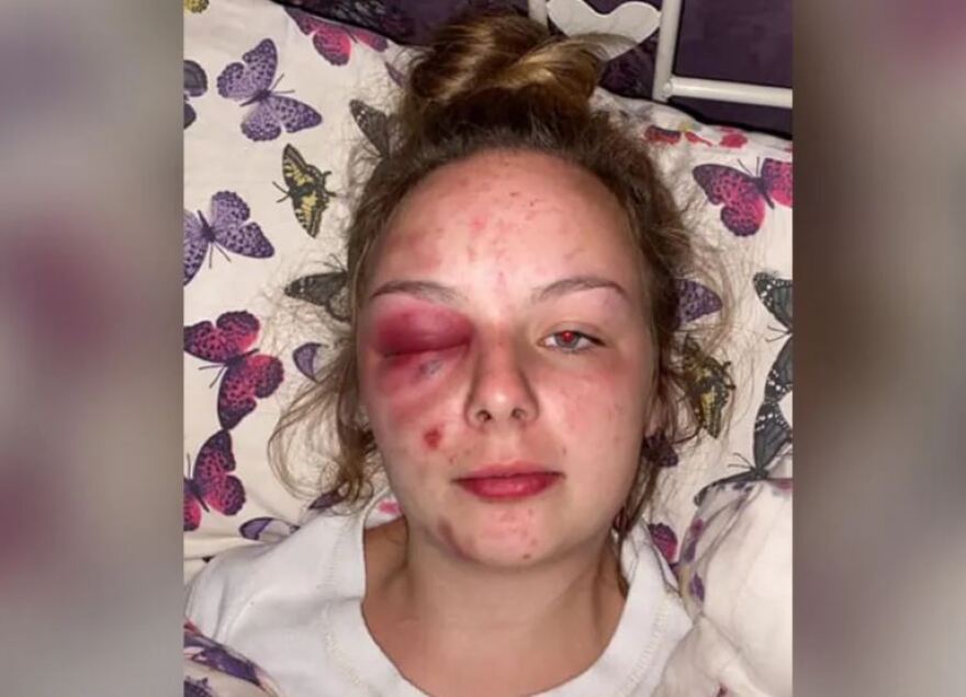 Βρετανίδα παρίστανε για χρόνια το θύμα trafficking και βιασμών - Αυτοτραυματίστηκε με σφυρί για να... πείσει