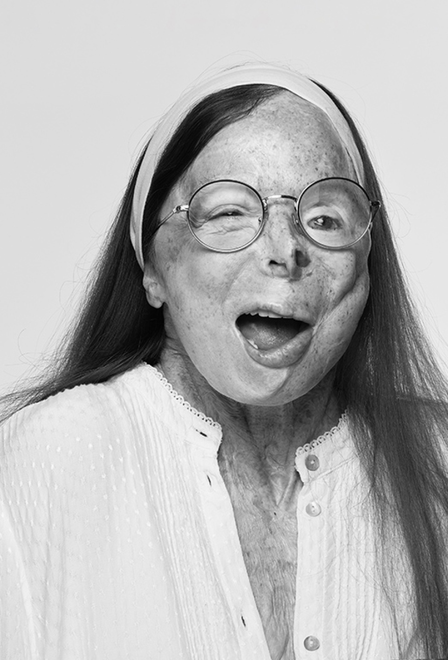 Βρετανός φωτογράφος δημιούργησε λεύκωμα - οδηγό μόδας με μοντέλο συγγραφέα που επέζησε επίθεσης με βιτριόλι