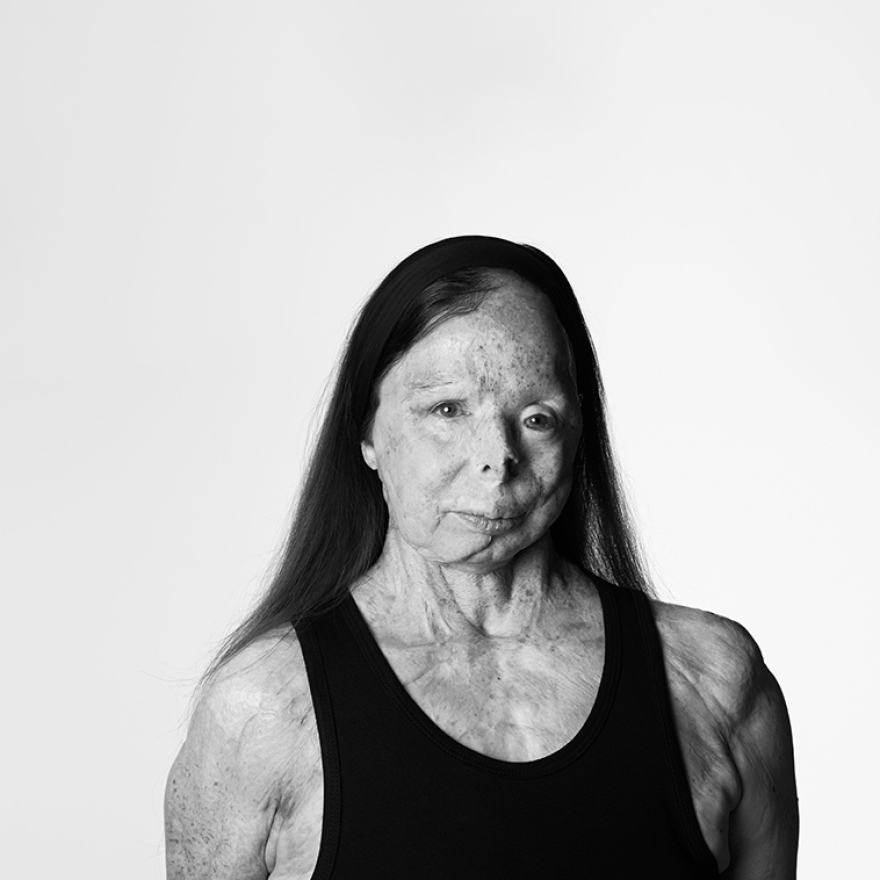 Βρετανός φωτογράφος δημιούργησε λεύκωμα - οδηγό μόδας με μοντέλο συγγραφέα που επέζησε επίθεσης με βιτριόλι