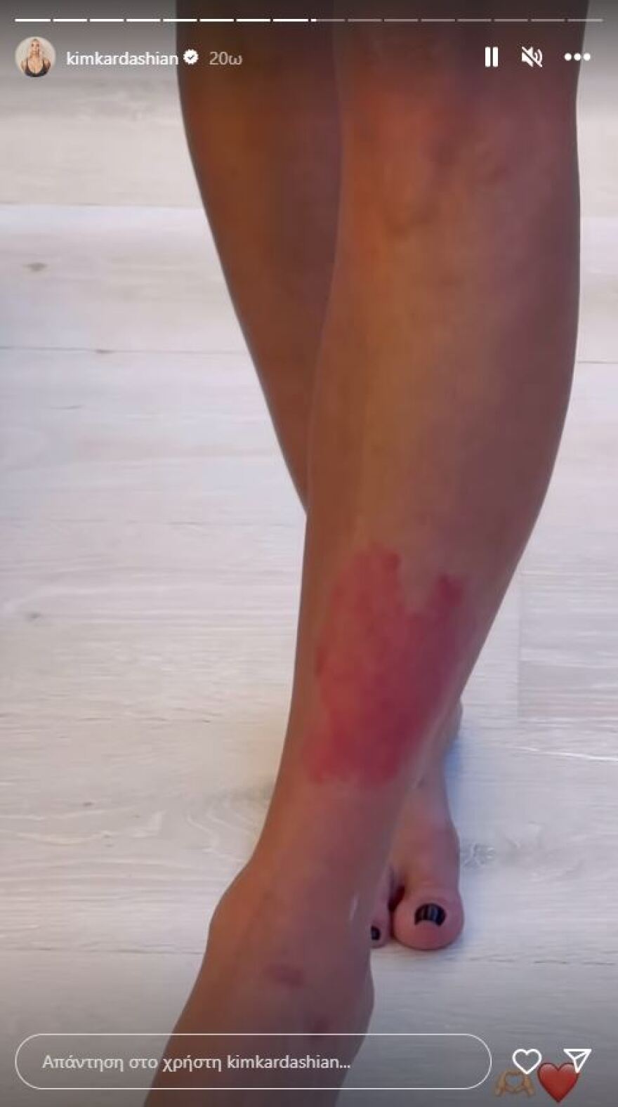 Κιμ Καρντάσιαν: Είναι πολύ επώδυνο, λέει για την ψωρίαση που την ταλαιπωρεί, δείχνοντας τα σημάδια στο σώμα της 