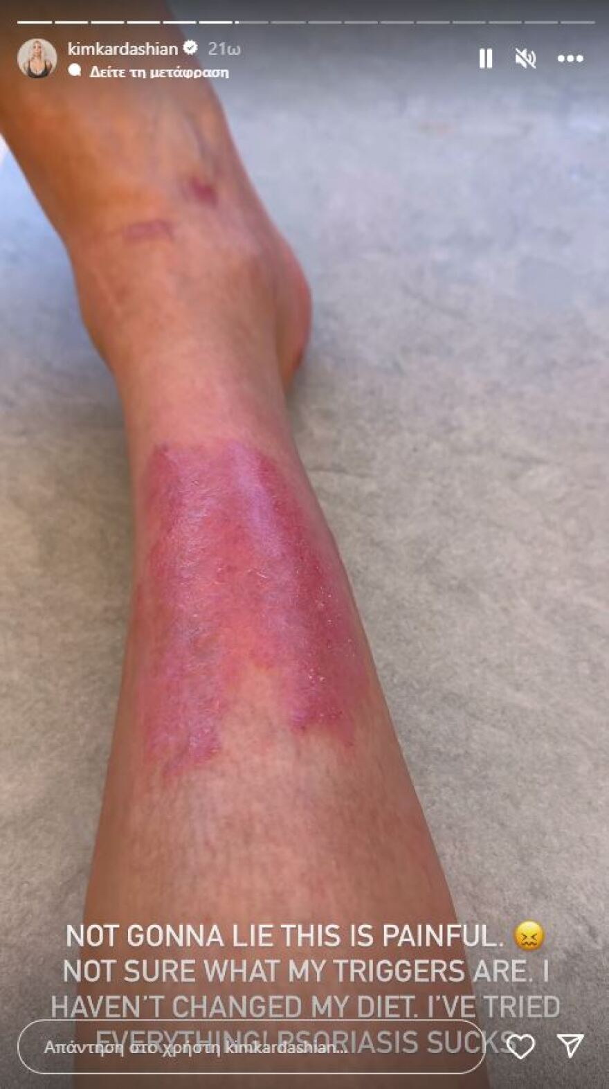 Κιμ Καρντάσιαν: Είναι πολύ επώδυνο, λέει για την ψωρίαση που την ταλαιπωρεί, δείχνοντας τα σημάδια στο σώμα της 