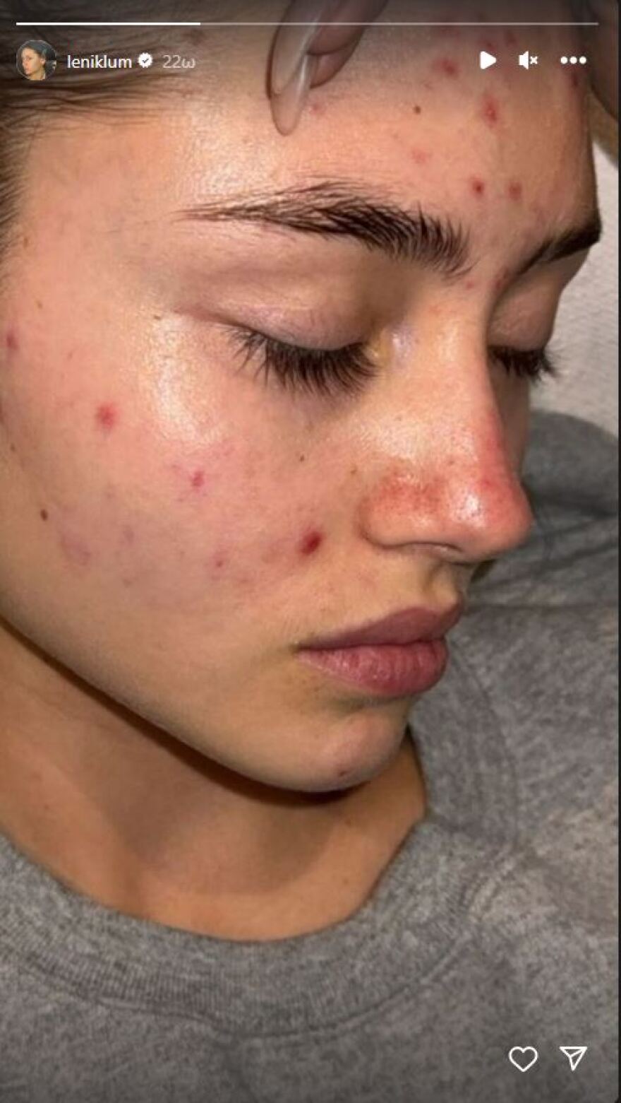 Λένι Κλουμ: Φωτογραφίζεται χωρίς μακιγιάζ και δείχνει τα σημάδια της ακμής στο πρόσωπό της