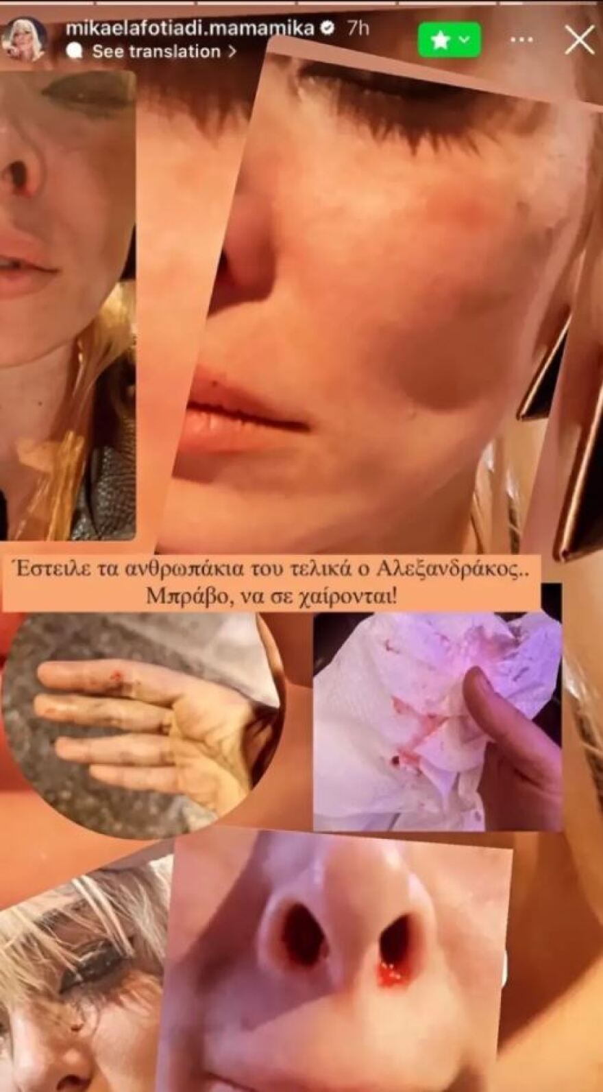 Μικαέλα Φωτιάδη - Οι δηλώσεις μετά τον ξυλοδαρμό της και η δημόσια έκκληση - Σεβαστείτε την κατάστασή μου