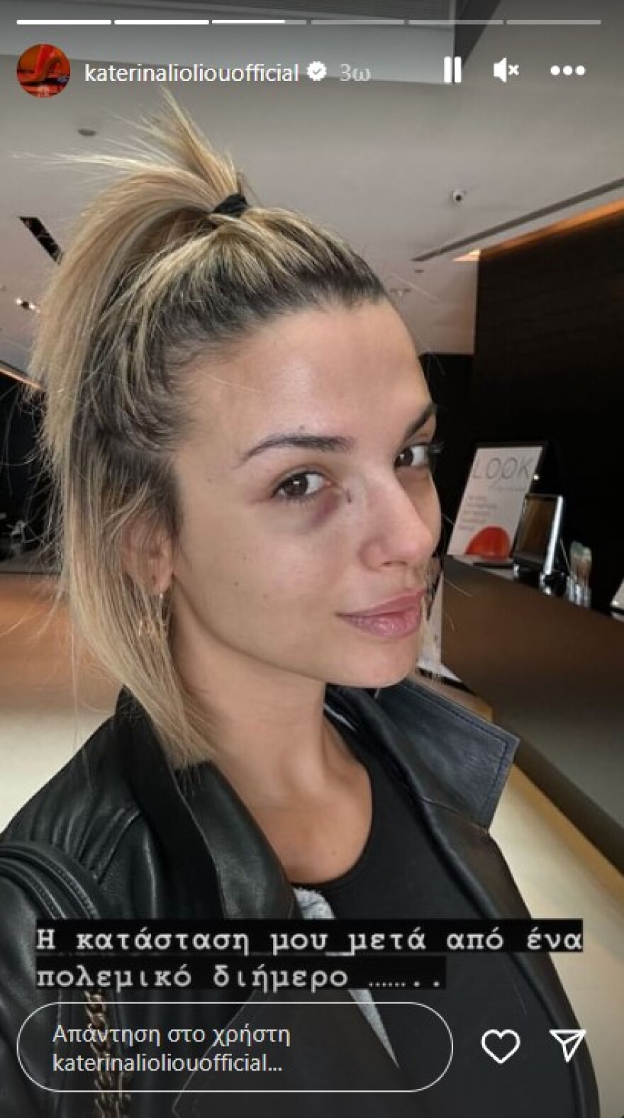 Κατερίνα Λιόλιου: Η φωτογραφία με μαυρισμένο μάτι μετά το αντικείμενο που της έριξαν επί σκηνής