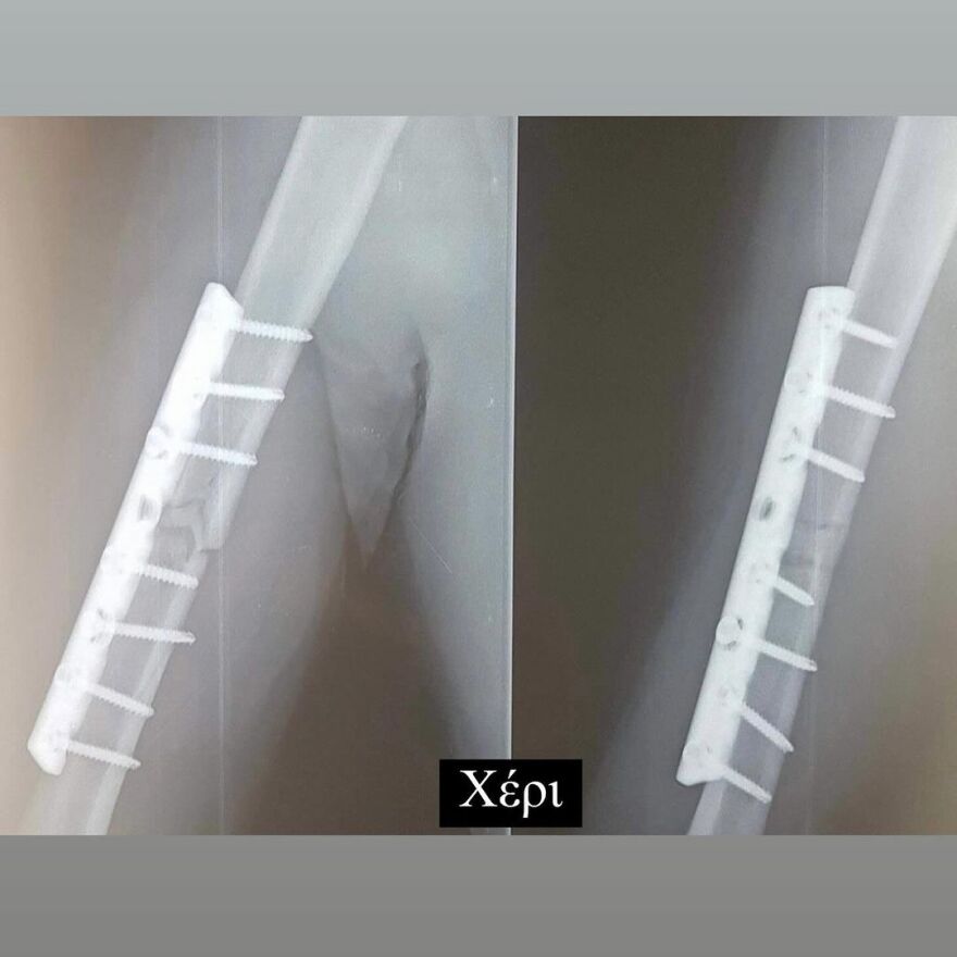 Ηλίας Βρεττός: Η ανάρτησή του για το ατύχημα που είχε - 6 χρόνια πέρασαν και όλα ακόμα μοιάζουν σαν χθες, γράφει