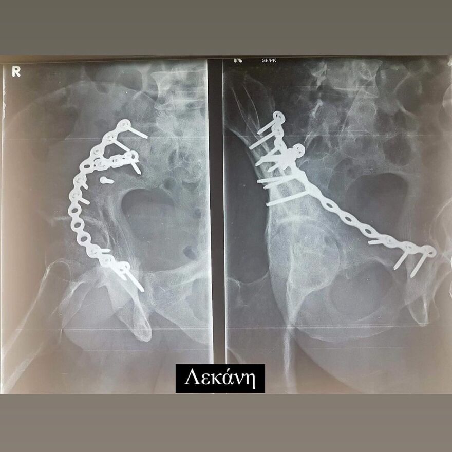 Ηλίας Βρεττός: Η ανάρτησή του για το ατύχημα που είχε - 6 χρόνια πέρασαν και όλα ακόμα μοιάζουν σαν χθες, γράφει