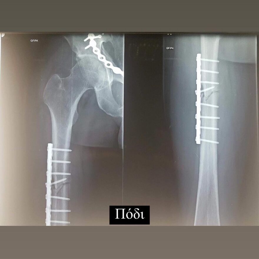 Ηλίας Βρεττός: Η ανάρτησή του για το ατύχημα που είχε - 6 χρόνια πέρασαν και όλα ακόμα μοιάζουν σαν χθες, γράφει