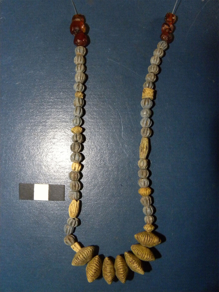 Σύνδρομο Down: Έρευνα εντόπισε την πρώτη γνωστή περίπτωση κατά την αρχαιότητα στην Ελλάδα