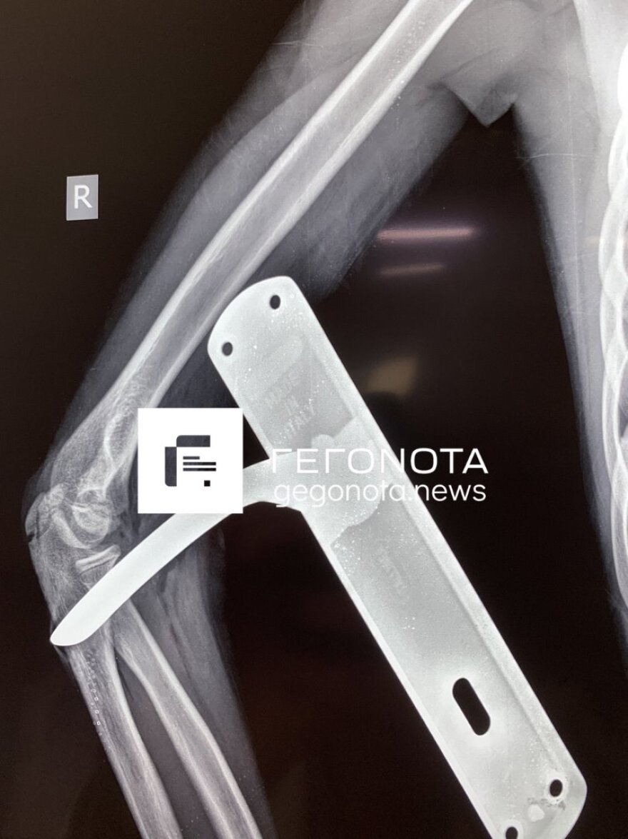 Βόλος: Πόμολο καρφώθηκε σε χέρι μαθητή - Μεταφέρθηκε στο νοσοκομείο