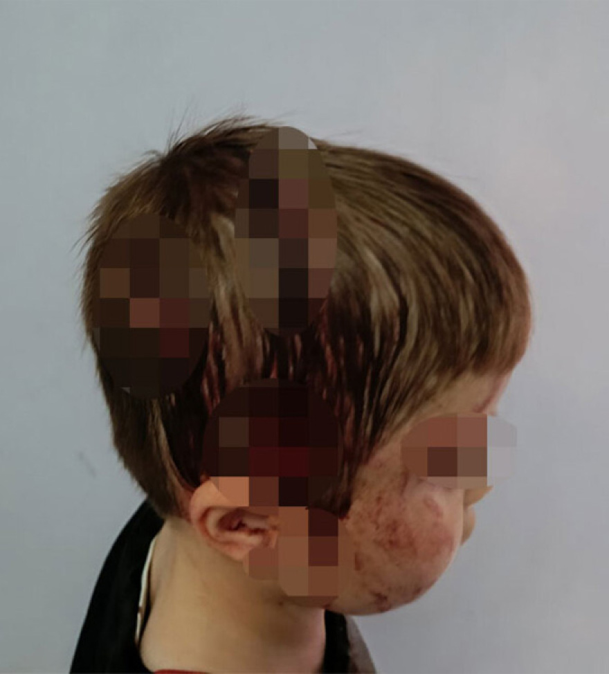 Γιαννιτσά: Η γιαγιά έσωσε τον 4χρονο που του επιτέθηκε σκύλος – Μήνυση κατά παντός υπευθύνου από την οικογένεια