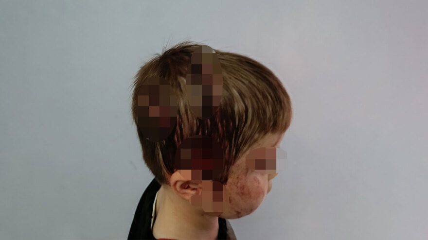 Γιαννιτσά: Σκύλος επιτέθηκε σε αγοράκι στη μέση του δρόμου