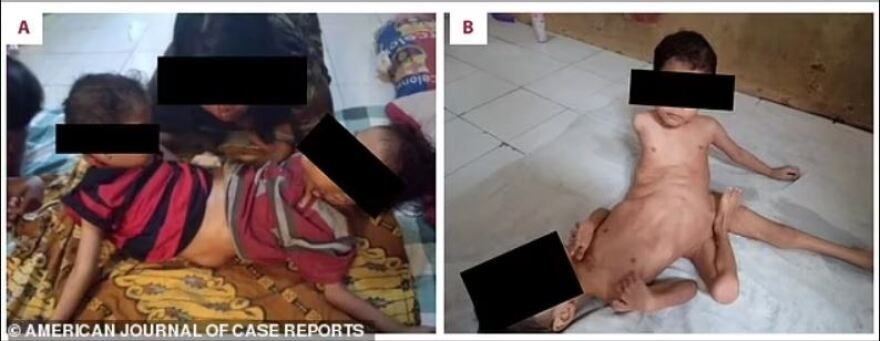 Ινδονησία: Σιαμαία ενωμένα στη λεκάνη - Πέρασαν ξαπλωμένα τα πρώτα τρία χρόνια της ζωής τους