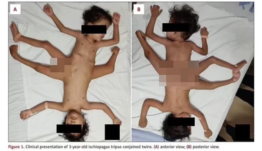 Ινδονησία: Σιαμαία ενωμένα στη λεκάνη - Πέρασαν ξαπλωμένα τα πρώτα τρία χρόνια της ζωής τους