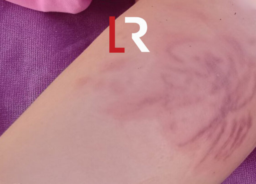 Φθιώτιδα: Σοβαρά εγκαύματα σε 4χρονη από θαλάσσια ανεμώνη