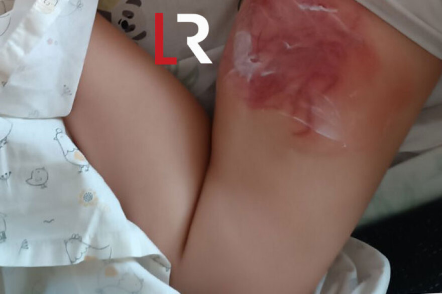 Φθιώτιδα: Σοβαρά εγκαύματα σε 4χρονη από θαλάσσια ανεμώνη