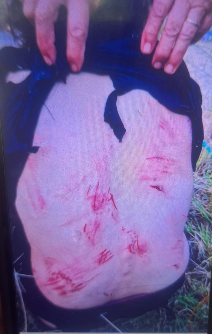 Θεσσαλονίκη: «Δέκα σκυλιά τη δάγκωναν όπου έβρισκαν», λέει η κόρη της 44χρονης που δέχθηκε επίθεση από αδέσποτα