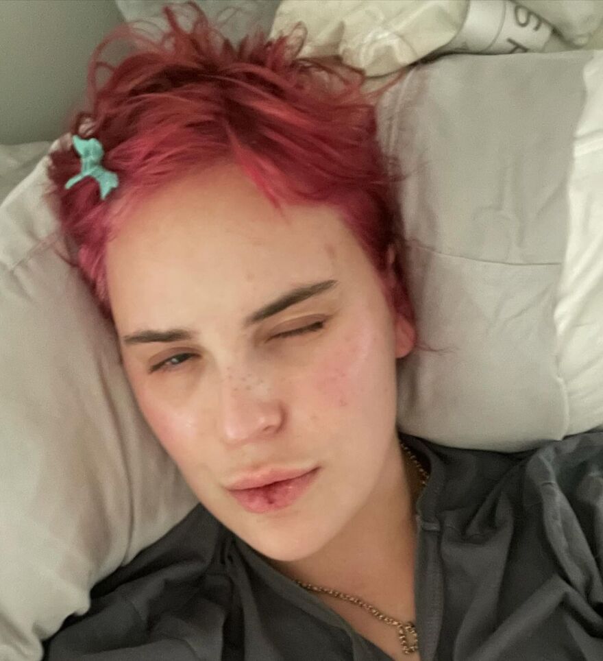 Ταλούλα Γουίλις: Μίλησε για την ψυχαναγκαστική διαταραχή από την οποία πάσχει - Σκαλίζει το δέρμα της