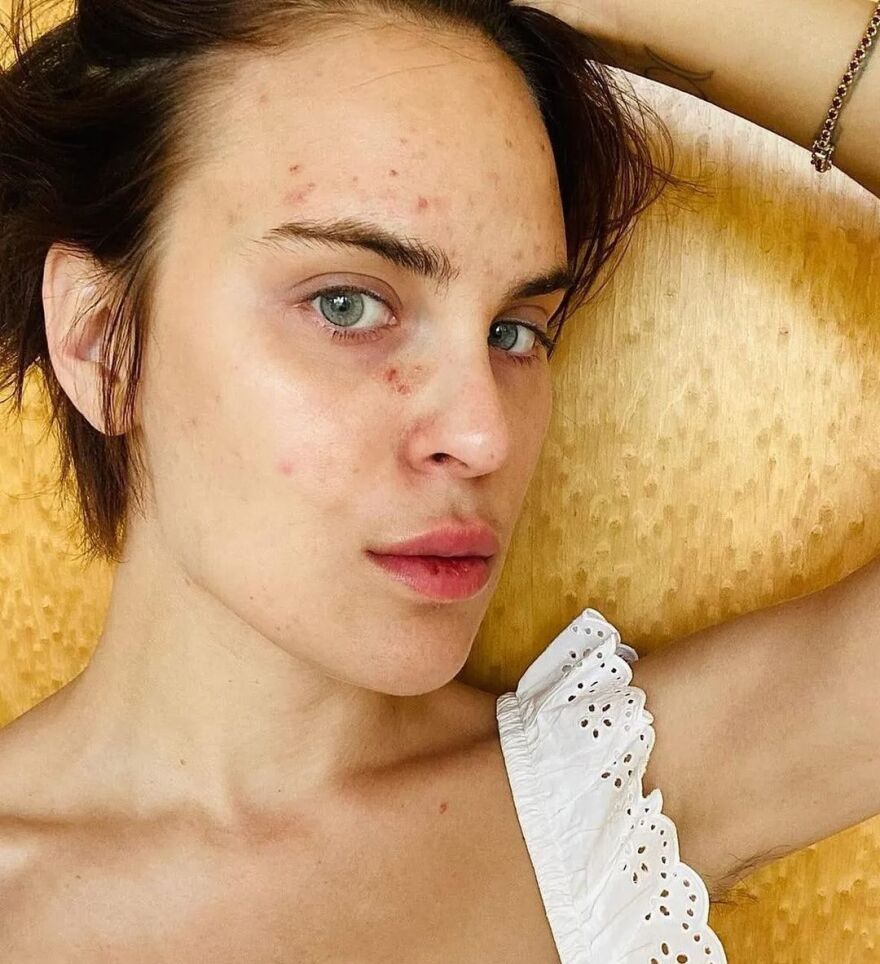 Ταλούλα Γουίλις: Μίλησε για την ψυχαναγκαστική διαταραχή από την οποία πάσχει - Σκαλίζει το δέρμα της