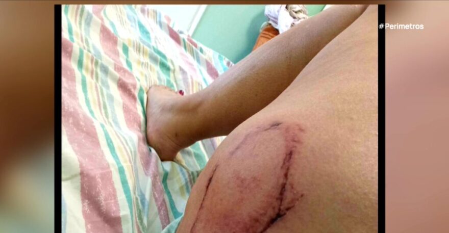 Επίθεση θαλάσσιας χελώνας σε λουόμενη στο Λιμένι - Δέχθηκε ισχυρό δάγκωμα, δείτε φωτογραφίες 