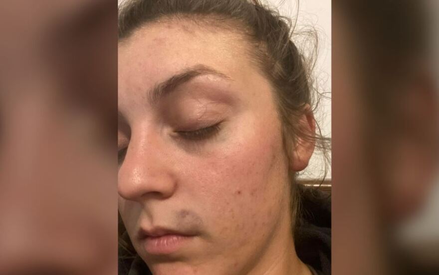 Καναδάς: Ζευγάρι ομοφυλόφιλων γυναικών δέχθηκε επίθεση από ομάδα 10 ανδρών αφού αντέδρασε σε ομοφοβικά σχόλια