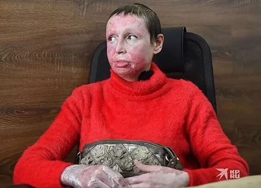 Ρωσία: 33χρονος βασάνισε 40χρονη αφού τον χώρισε - Τη «σταύρωσε» και της έβαλε φωτιά