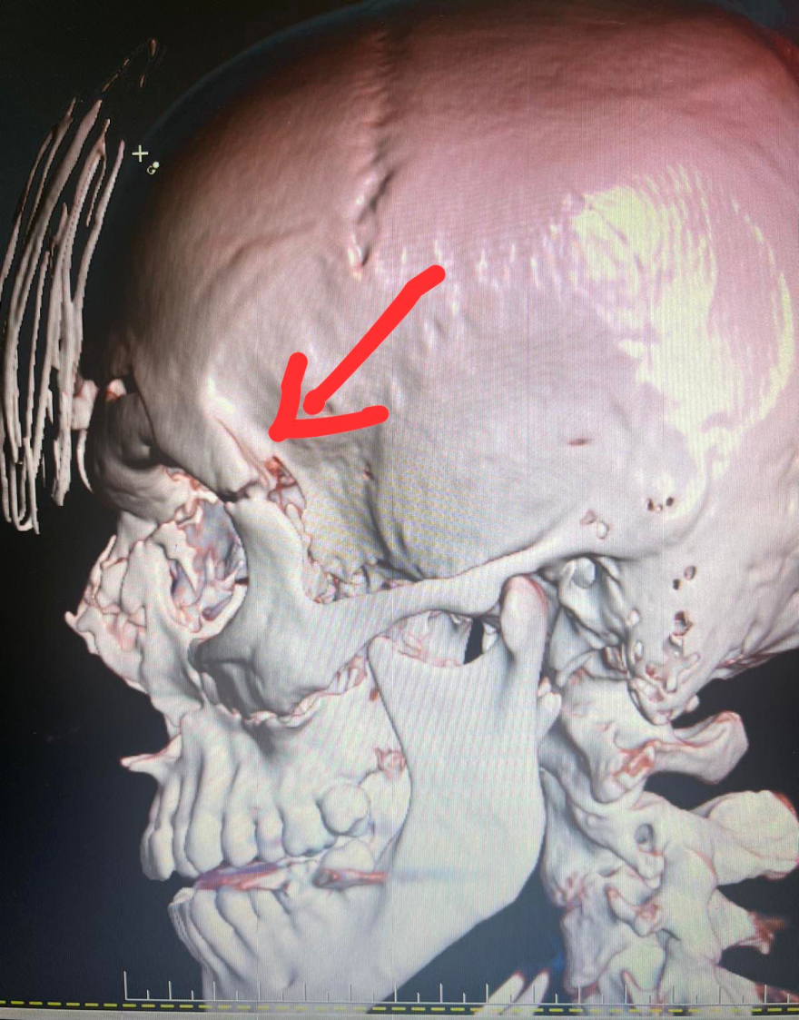 Κρήτη: Τα χτυπήματα που δέχθηκε ο Ελληνοκαναδός θα μπορούσαν να του στοιχίσουν τη ζωή του, λέει ο γιατρός του