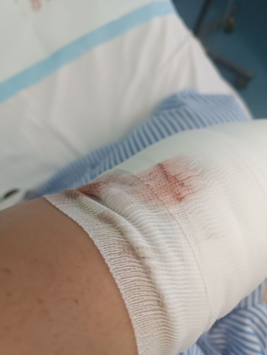 Χαλκιδική: «Η ιδιοκτήτρια του σκύλου μου φώναξε να τρέξω», λέει η 39χρονη που δέχθηκε επίθεση από το ζώο