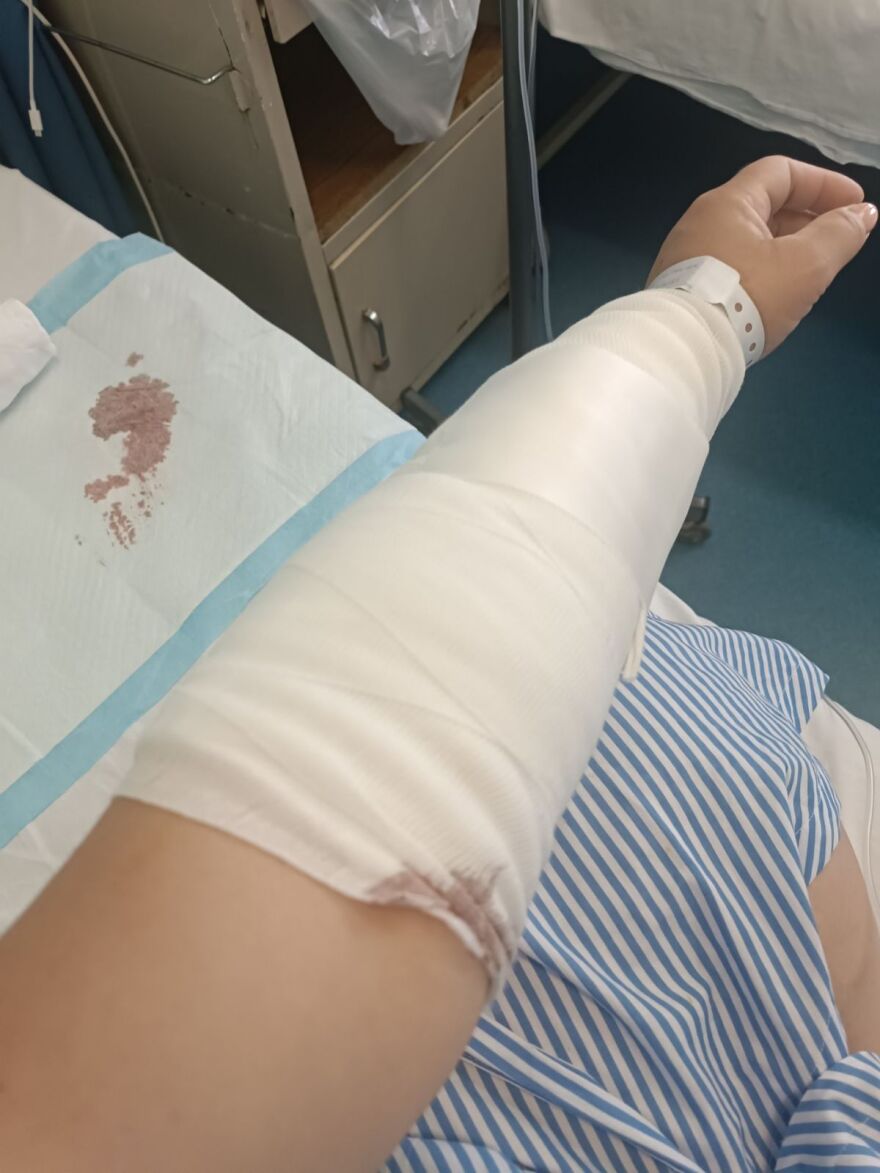 Χαλκιδική: «Η ιδιοκτήτρια του σκύλου μου φώναξε να τρέξω», λέει η 39χρονη που δέχθηκε επίθεση από το ζώο