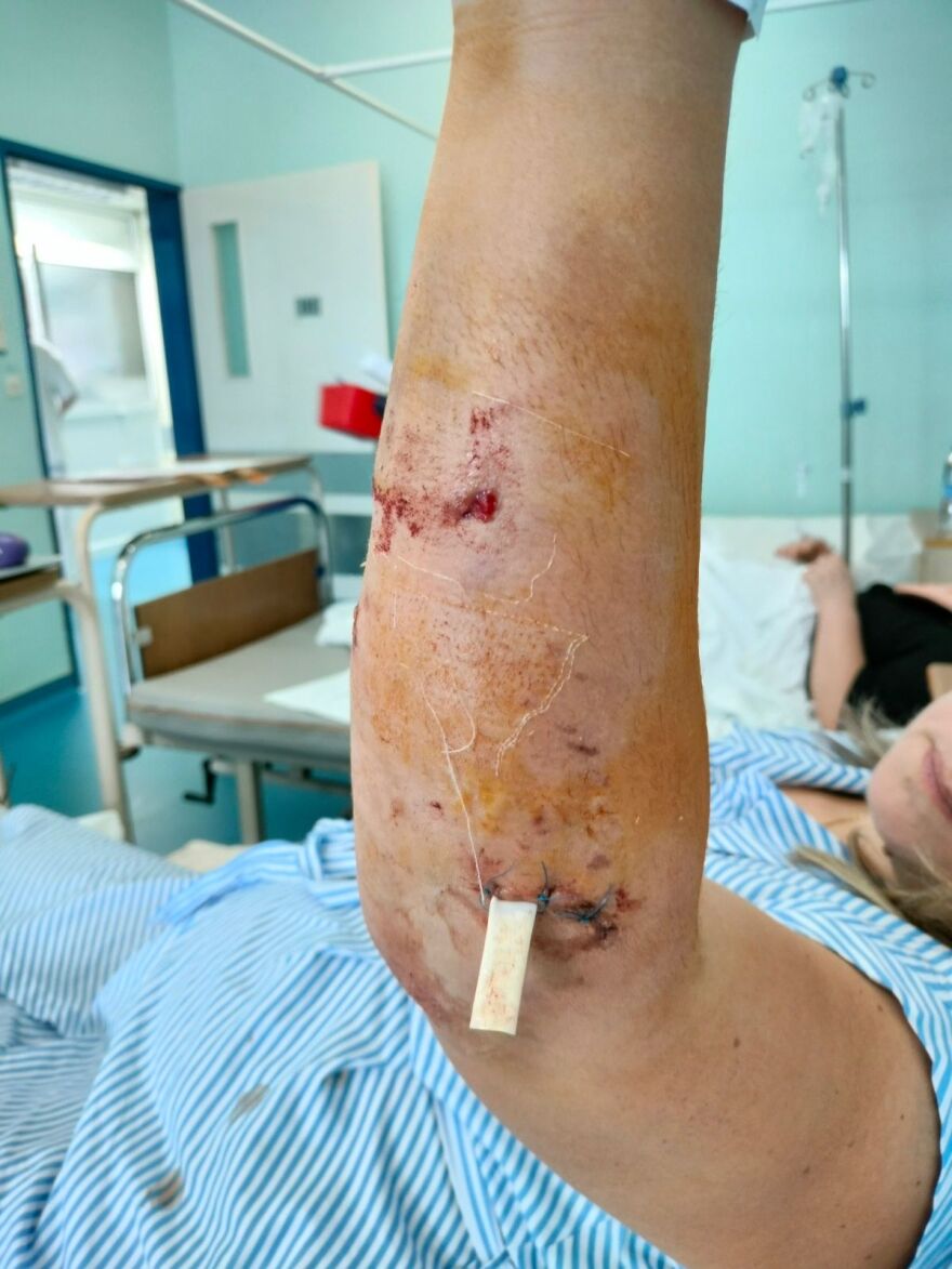 Χαλκιδική: «Η ιδιοκτήτρια του σκύλου μου φώναξε να τρέξω», λέει η 39χρονη που δέχθηκε επίθεση από το ζώο