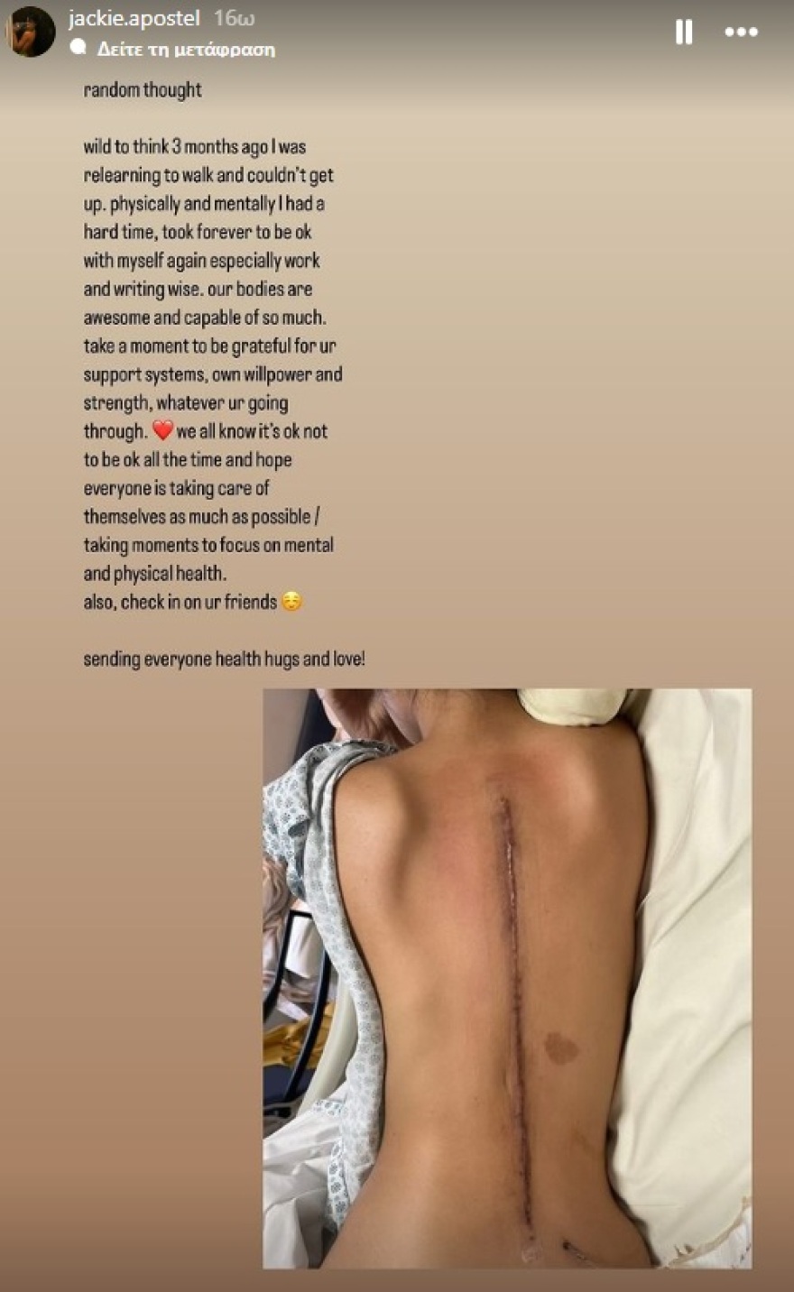 Κρουζ Μπέκαμ: Η σύντροφος του Τζάκι Αποστέλ δείχνει την ουλή στην πλάτη της και αποκαλύπτει πως έμαθε να περπατάει ξανά