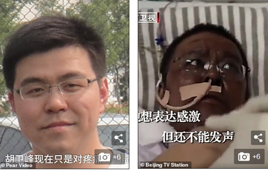 Κορωνοϊός: Μαύρο... έγινε το δέρμα δύο Κινέζων γιατρών που νόσησαν από τον ιό 