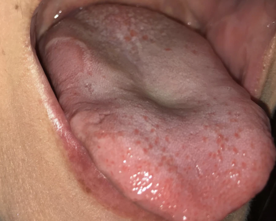 SOS από Βρετανούς επιστήμονες: Αναγκαία η ένταξη της «γλώσσας κορωνοϊού» στα επίσημα συμπτώματα