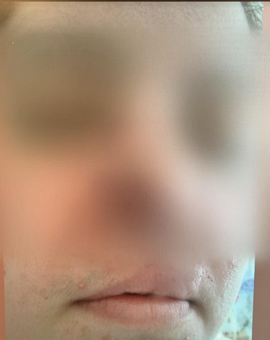 Η μάχη 35χρονης στο νοσοκομείο μετά την επίθεση από πιτ μπουλ που υιοθέτησε