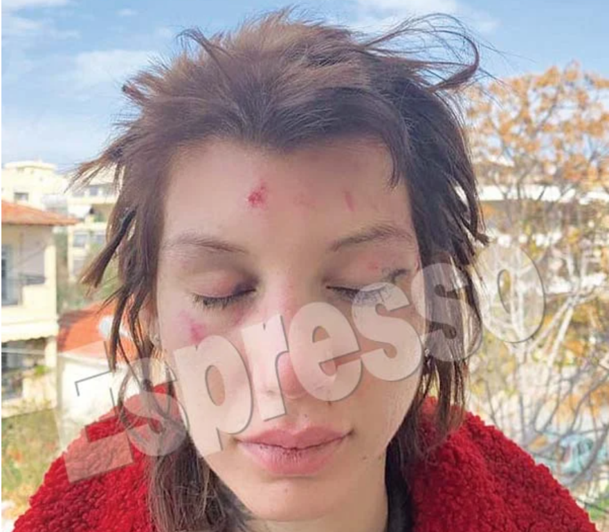 Εφιάλτης για τη Μαρία Αλεξάνδρου: Έξι γυναίκες την απήγαγαν, την χτύπησαν και την κούρεψαν - Φωτογραφίες σοκ