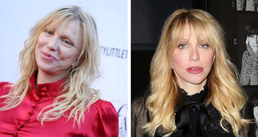 Ποιες διάσημες παραμορφώθηκαν μετά από πλαστικές επεμβάσεις