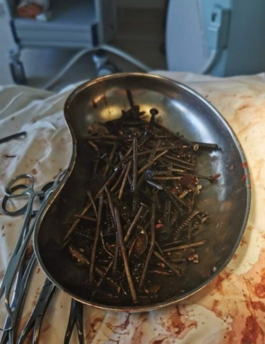 Λιθουανία: Ένα κιλό βίδες και καρφιά στο στομάχι ενός ασθενούς - Δείτε φωτογραφία 