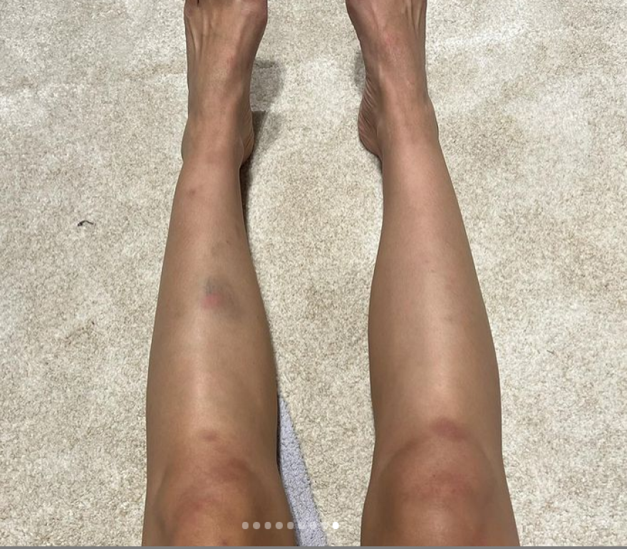 Η Ελένη Φουρέιρα δείχνει τις μελανιές της