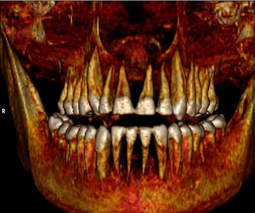 Τι αποκάλυψε το ψηφιακό «ξετύλιγμα» της μούμιας του Φαραώ Αμένοφι Α'