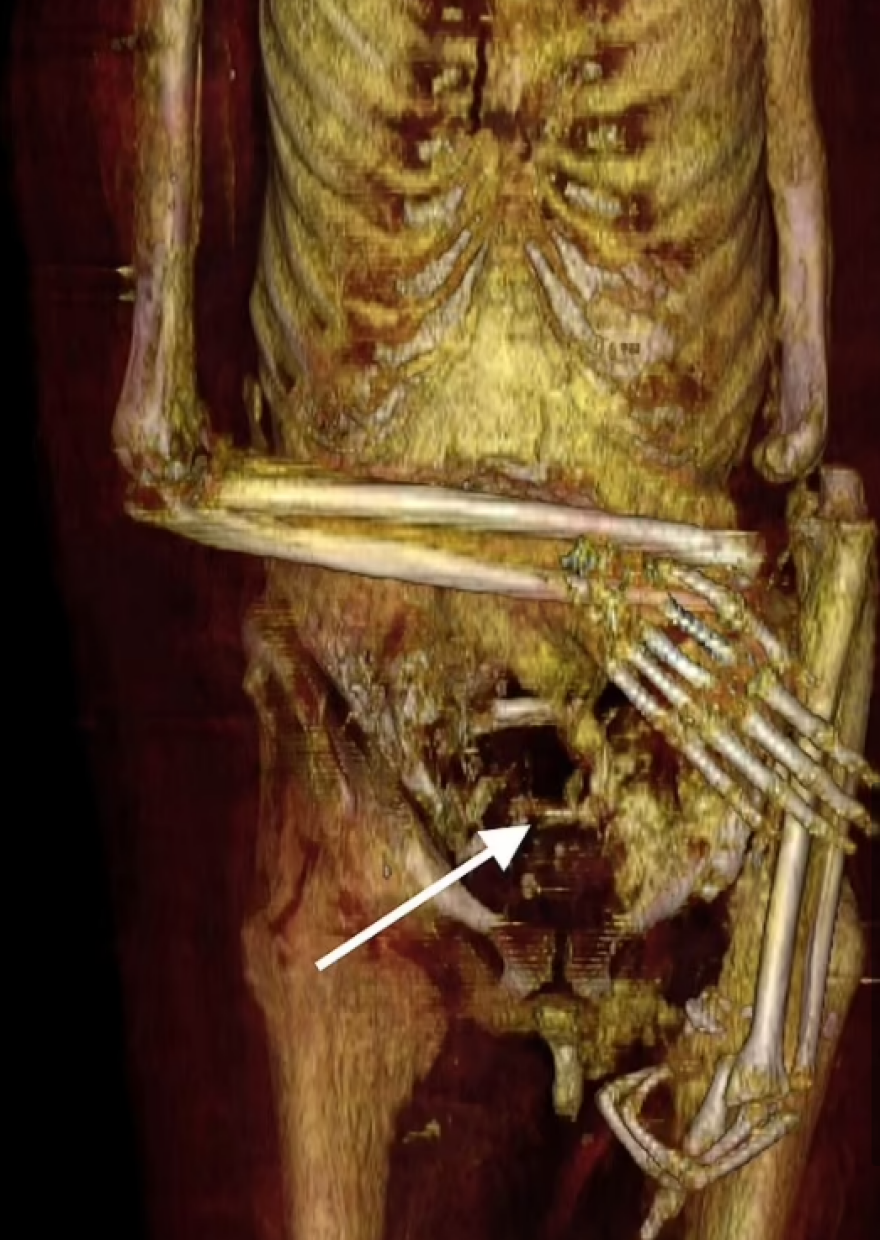 Τι αποκάλυψε το ψηφιακό «ξετύλιγμα» της μούμιας του Φαραώ Αμένοφι Α'