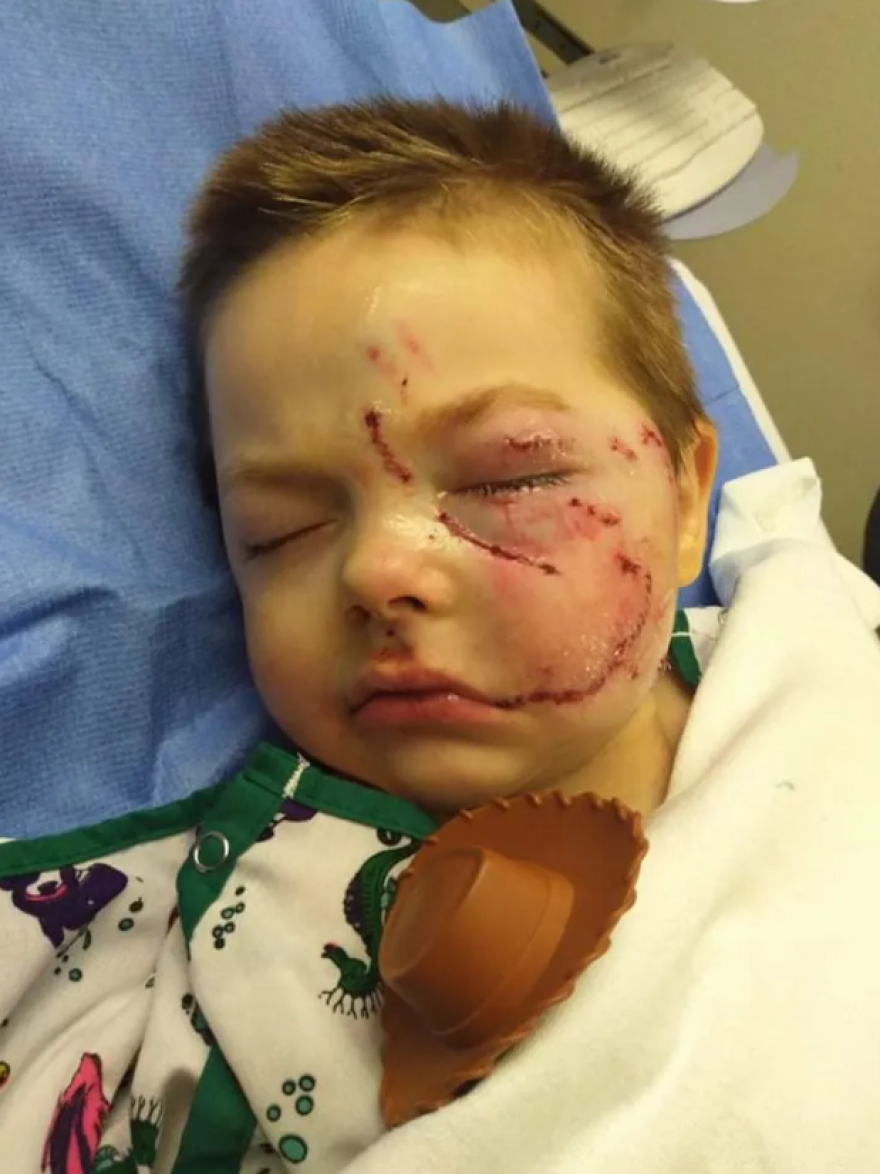 Ένα πεντάχρονο παιδί έχασε το χαμόγελό του μετά από επίθεση του σκύλου του - Προσοχή σκληρές εικόνες