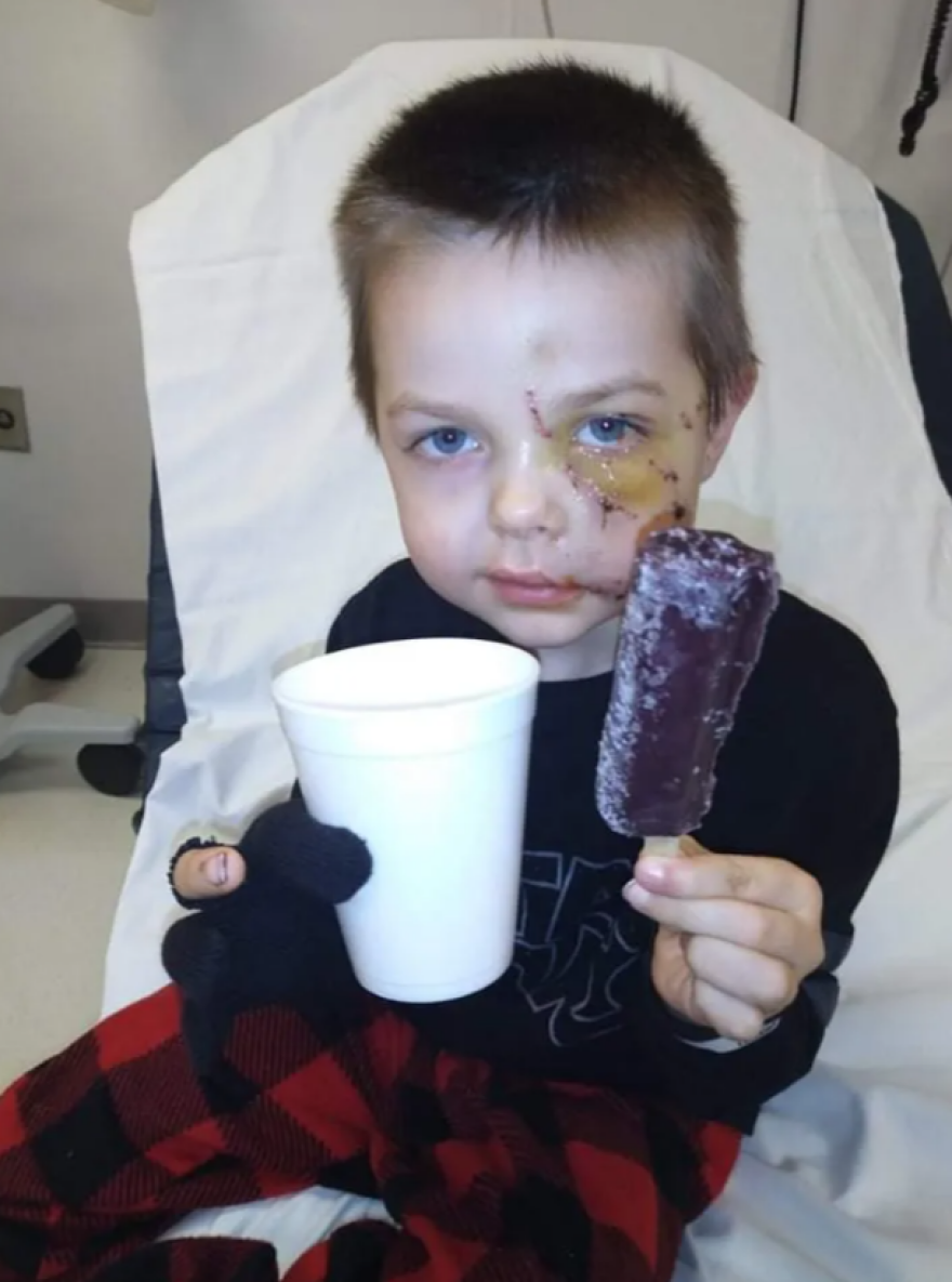 Ένα πεντάχρονο παιδί έχασε το χαμόγελό του μετά από επίθεση του σκύλου του - Προσοχή σκληρές εικόνες