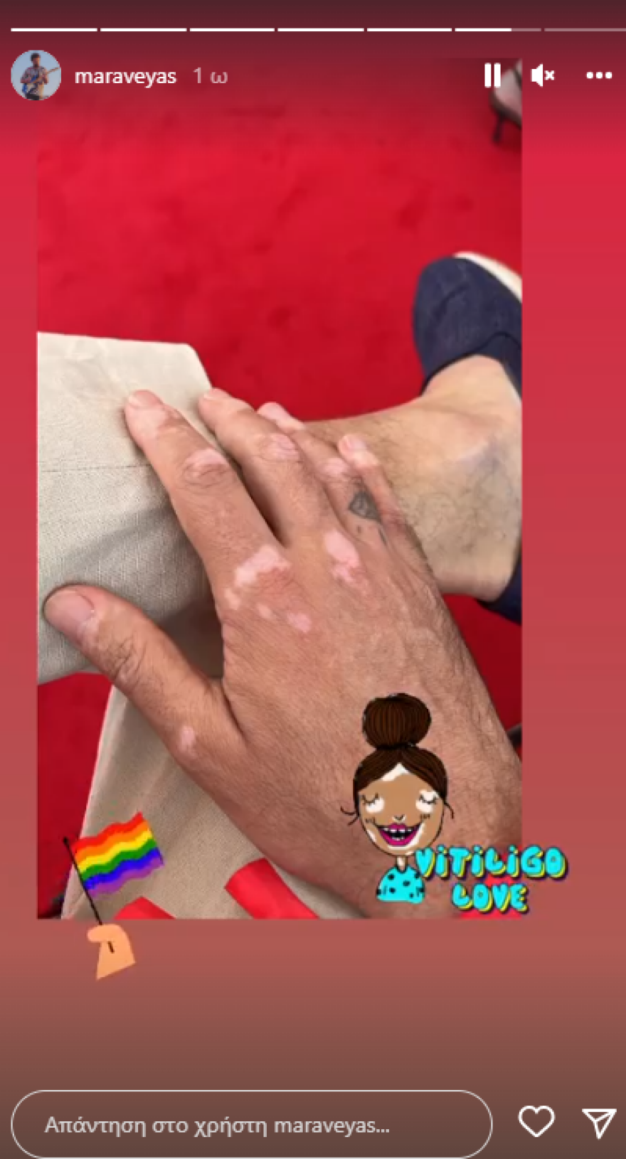 Ο Κωστής Μαραβέγιας δείχνει τα σημάδια της λεύκης στα χέρια του και περνά το μήνυμά του