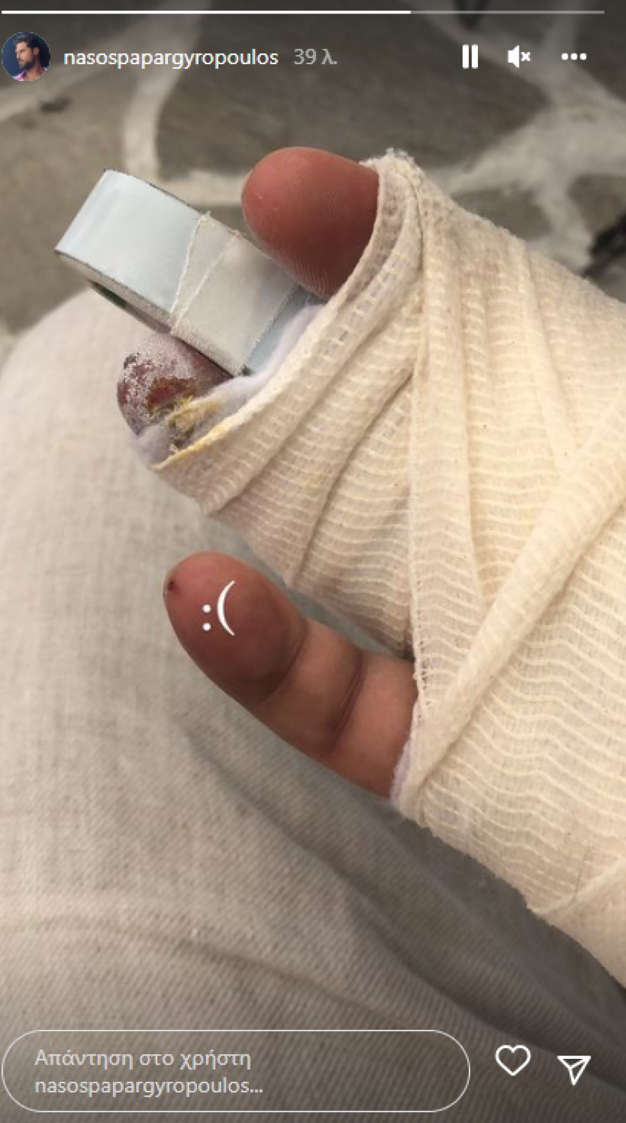 Νάσος Παπαργυρόπουλος: Ατύχημα με τη μοτοσικλέτα του στη Μήλο