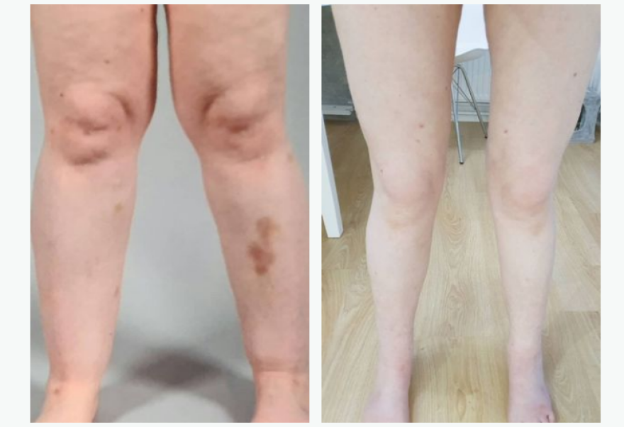 Φινλανδία: Μία γυναίκα κρυβόταν από την ηλικία των 12 ετών επειδή είχε «πόδια ελέφαντα» -Έπασχε από σπάνια ασθένεια