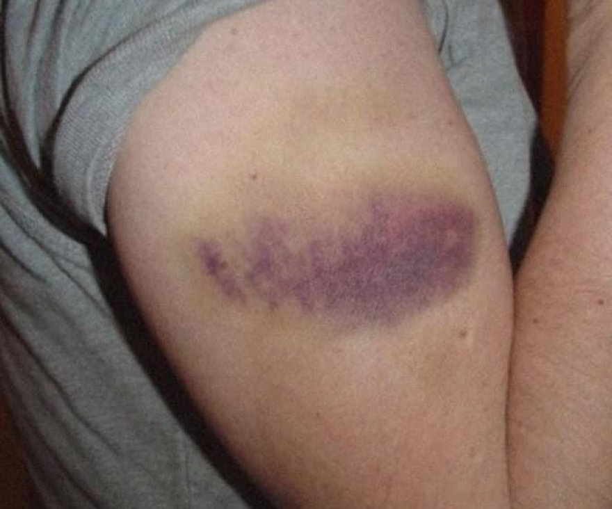 Σαλαμίνα: «Πολύ λεπτή η γραμμή ανάμεσα στη ζωή και τον θάνατο» γράφει διασώστης του ΕΚΑΒ μετά τον άγριο ξυλοδαρμό του